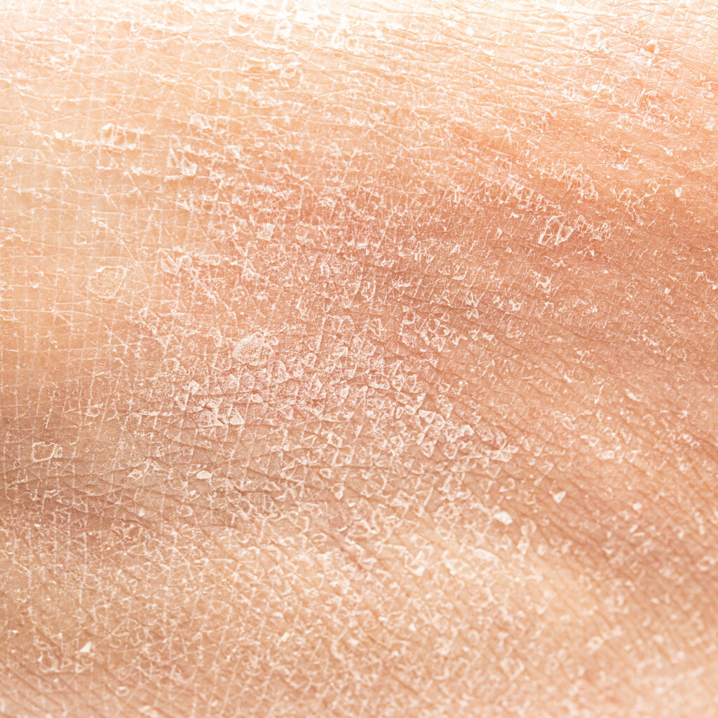 Типы и причины появления чешуек на коже