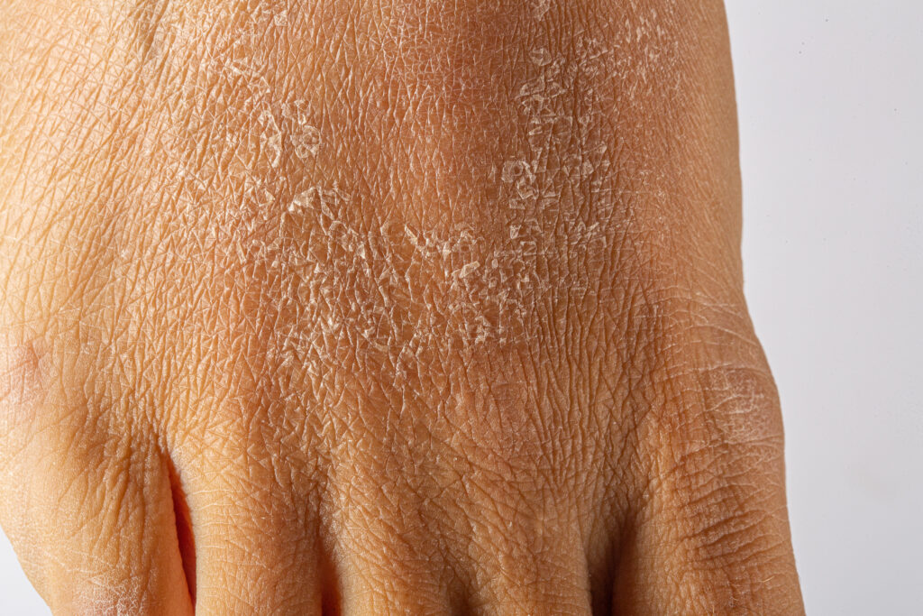 DERMAQUEST » Шелушение кожи после химического пилинга| Статьи | Отзывы | Купить